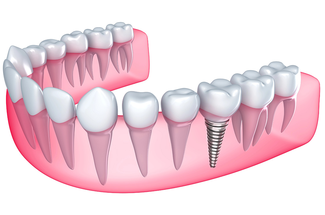 dental-implants